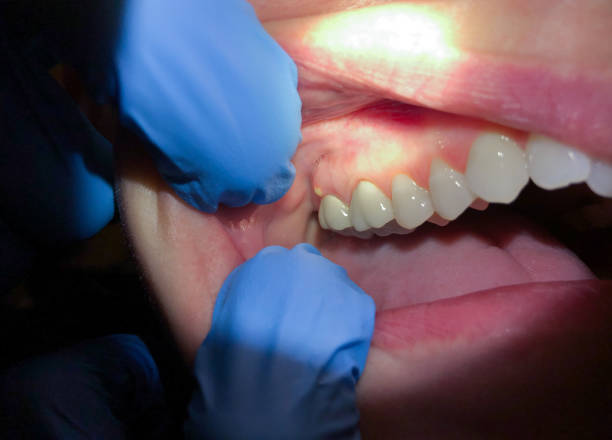 Best Emergency Treatment for Dental Infections or Abscesses in USA